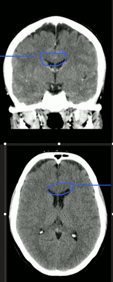 <p>What Portion of the Corpus Callosum is this?</p>