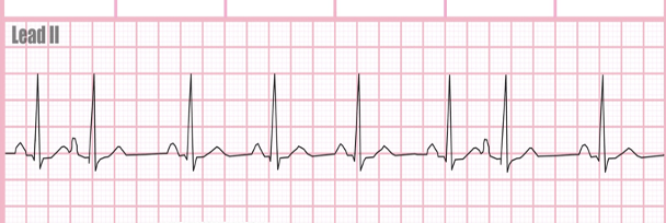 <p><strong>Signs/Symptoms:</strong></p><ul><li><p class="">The patient may say, “My heart skipped a beat.”</p></li><li><p class="">Possible pulse deficit (difference between apical and radial pulse rate).</p></li></ul><p class=""><strong>Causes:</strong></p><ul><li><p class="">Caffeine, alcohol, nicotine</p></li><li><p class="">Stretched atrial myocardium (e.g., as in hypervolemia)</p></li><li><p class="">Stress/anxiety</p></li><li><p class="">Electrolyte imbalances</p></li><li><p class="">Atrial ischemia, injury, or infarction</p></li></ul><p class=""><strong>Treatment:</strong></p><ul><li><p class=""><strong>Treat the underlying cause</strong>:</p><ul><li><p class="">Replace electrolytes</p></li><li><p class="">Reduce stress/anxiety</p></li><li><p class="">Dietary changes</p></li></ul></li><li><p class=""><strong>Asymptomatic</strong> = no treatment</p></li><li><p class=""><strong>Symptomatic</strong> = <em><u>Amiodarone and beta-blockers</u></em></p></li></ul><p></p>