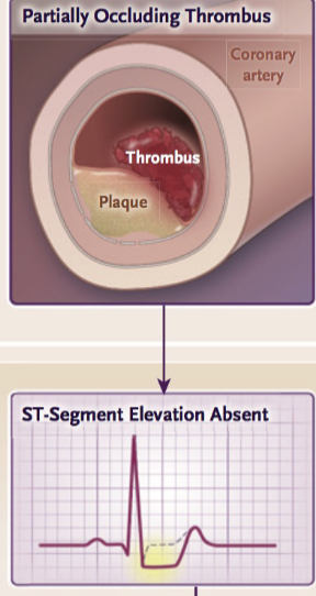 Partially obstructs the coronary artery, leading to myocardial ischemia.
