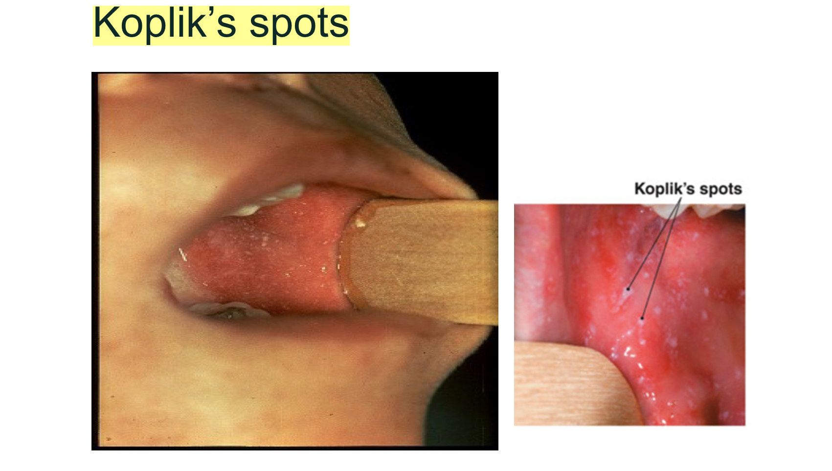 <p><span><strong>Virus</strong></span></p><p class="p1"><span><strong>• RNA virus</strong></span></p><p class="p1"><span><strong>• Family: <em>Paramyxoviridae</em></strong></span></p><p class="p1"><span><strong>• Humans only reservoir</strong></span></p><p class="p2"></p><p class="p1"><span><strong>Transmission</strong></span></p><p class="p1"><span><strong>• Inhalation of respiratory droplets</strong></span></p><p class="p2"></p><p class="p1"><span><strong>Incubation Period</strong></span></p><p class="p1"><span><strong>• 10–14 days</strong></span></p><p class="p2"></p><p class="p1"><span><strong>Pathogenesis</strong></span></p><p class="p1"><span><strong>• Virus enters respiratory epithelium</strong></span></p><p class="p1"><span><strong>• Replicates → spreads via bloodstream</strong></span></p><p class="p1"><span><strong>• Infects endothelial cells</strong></span></p><p class="p1"><span><strong>• Rash due to T-cell immune response</strong></span></p><p class="p2"></p><p class="p1"><span><strong>Clinical Features</strong></span></p><p class="p1"><span><strong>• Prodrome:</strong></span></p><p class="p1"><span><strong>• Fever</strong></span></p><p class="p1"><span><strong>• Cough</strong></span></p><p class="p1"><span><strong>• Coryza</strong></span></p><p class="p1"><span><strong>• Conjunctivitis</strong></span></p><p class="p1"><span><strong>• Koplik spots: bluish-white spots on buccal mucosa (diagnostic)</strong></span></p><p class="p1"><span><strong>• Rash: Maculopapular starts on face → spreads downward</strong></span></p><p class="p2"></p><p class="p1"><span><strong>Complications</strong></span></p><p class="p1"><span><strong>• Ear infection</strong></span></p><p class="p1"><span><strong>• Pneumonia</strong></span></p><p class="p1"><span><strong>• Encephalitis</strong></span></p><p class="p1"><span><strong>• Subacute sclerosing panencephalitis (SSPE)</strong></span></p><p class="p2"></p><p class="p1"><span><strong>Diagnosis</strong></span></p><p class="p1"><span><strong>• IgM antibodies</strong></span></p><p class="p1"><span><strong>• RT-PCR from throat or nasopharyngeal samples</strong></span></p>