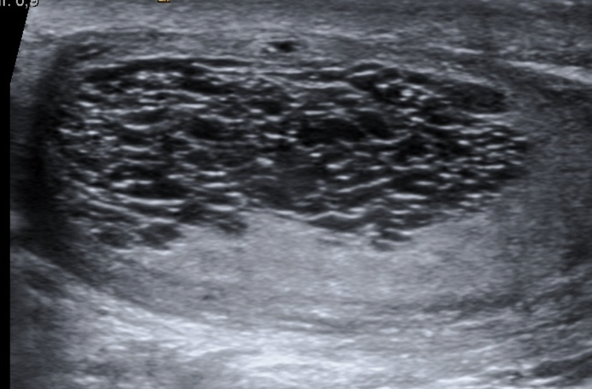 <p><strong>Dilated rete testis</strong> near the mediastinum; benign and often post-vasectomy.</p>