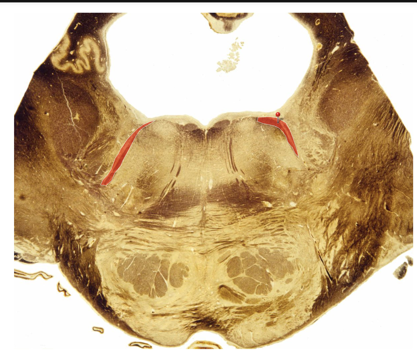 <p>Motor Root CNVII</p>