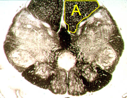 <p>Describe the signs/symptoms you will see if structure "A" is lesioned.</p><p><span>A. Contralateral loss of pain and temperature to the body</span></p><p><span>B. Ipsilateral hypertonia to the body</span></p><p><span>C. Contralateral spastic paresis to the body</span></p><p><span>D. Ipsilateral loss of vibratory sense to the body</span></p><p><span>E. Ipsilateral flaccid paralysis to the body</span></p><p></p>