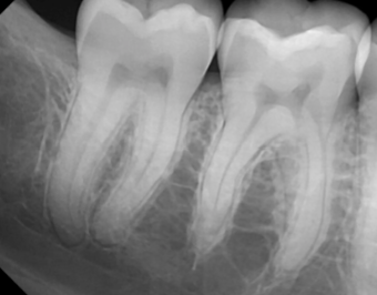 <ul><li><p><strong>Normal PDL</strong></p></li><li><p><strong>Superimposed Anatomy</strong></p></li></ul><p></p>