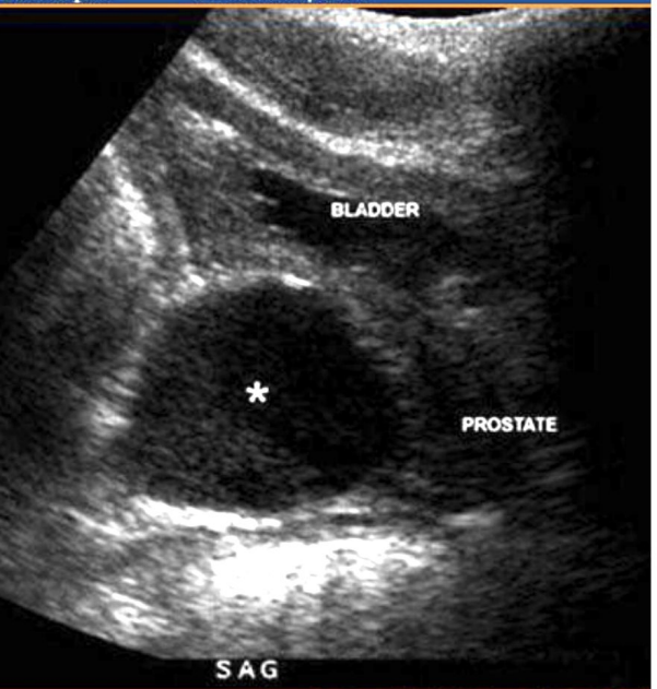 <p>Which type of cyst is shown?</p>