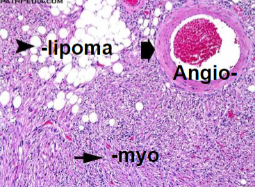 <p>Angiomyolipoma</p>