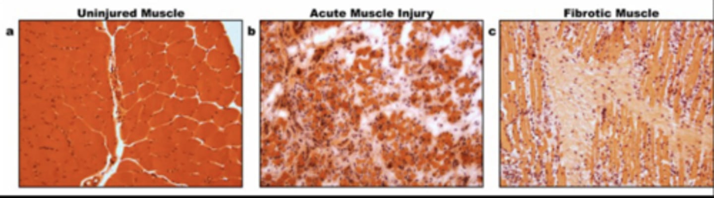 <p>Formation of excessive fibrotic tissue</p><p>- Occurs when normal tissue is immobile</p><p>- Scarring continues to happen beyond normal timeframe</p><p>Abnormal result = Scarring after prolonged immobilization</p>