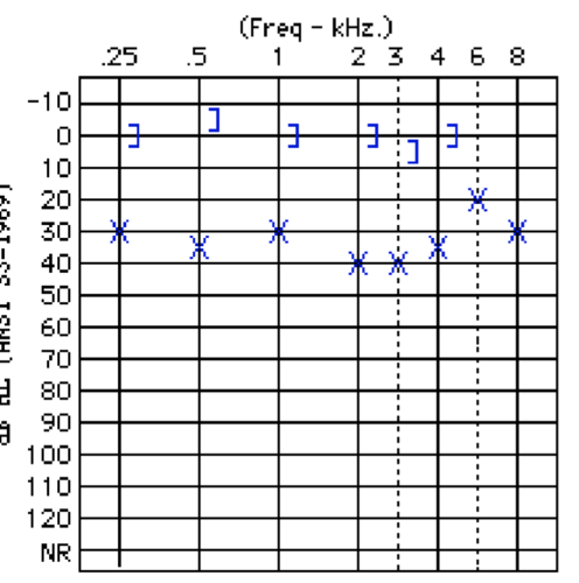 <p>500 Hz = 35 dB HL</p><p>1000 Hz = 30 dB HL</p><p>2000 Hz = 40 dB HL</p><p>4000 Hz = 35 dB HL</p><p>PTA?</p><p>HFPTA?</p><p>answer:</p><p>(PTA = 78.3 dB HL) - severe hearing loss</p><p>(HFPTA = 113.8 dB HL) - profound hearing loss</p>
