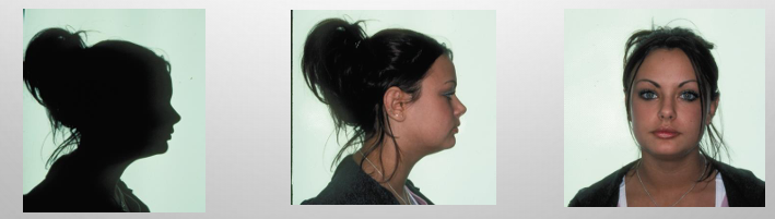 <p>-brachycephalic: an individual with a larger than average cranial width and usually presents with a broad, square head shape and low mandibular plane angle</p><p>-brachyfacial: an individual characterized by a broad square face with a strong chin, flat lip posture, and a low mandibular plane angle</p>