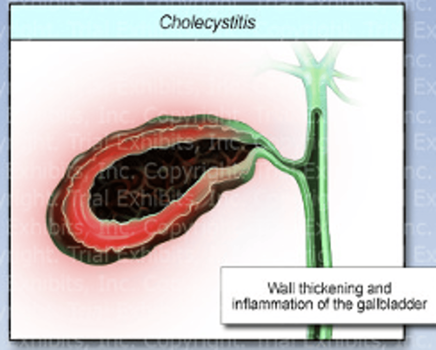 <p>inflammation of the gallbladder</p><p>-caused by gallstone obstruction or stasis</p>