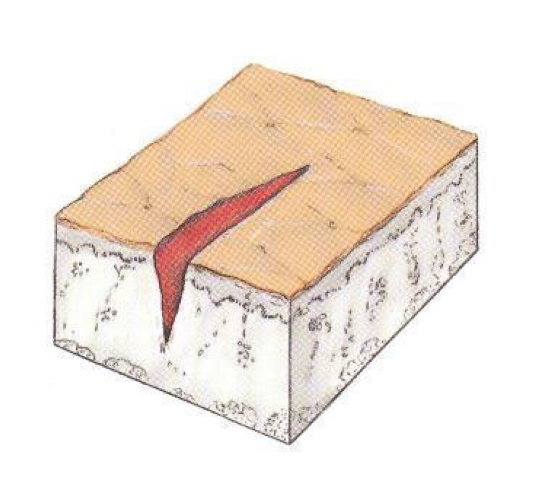 <p>what type of skin lesion is this? </p>