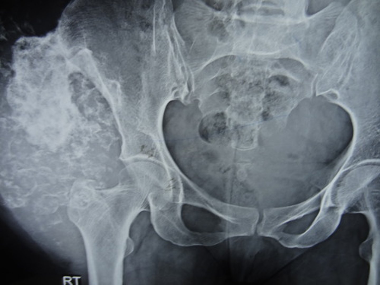 <p>Malignant tumors</p><p></p><p>Adult – <strong>________________</strong></p><p>- Metastases are also common</p>