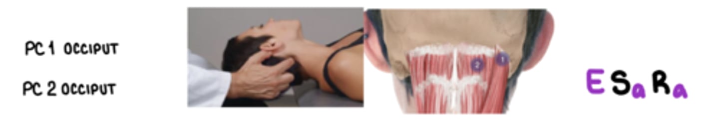 <p>E Sa Ra</p><p>on inferior nuchal line midway b/w inion and mastoid</p><p>splenius capitis, rectus capitis posterior major/minor, oblique capitis superior mm.</p>
