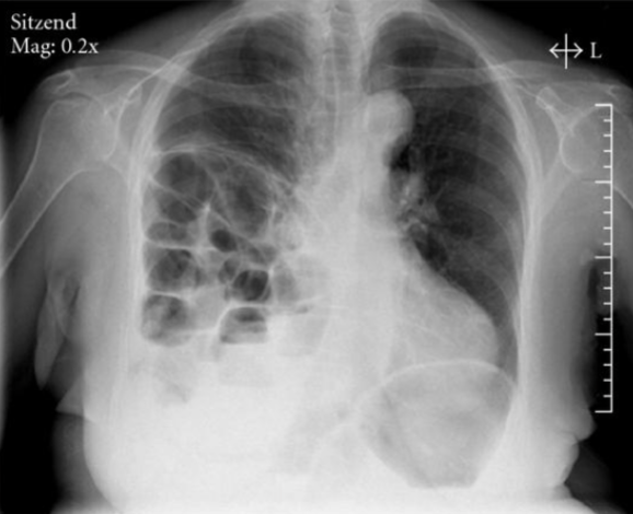 <p><u>Cause</u>: usually due to trauma, more common on the left side</p><p><u>Imaging</u>: loops of bowel in the lower chest cavity, best seen on CXR</p>