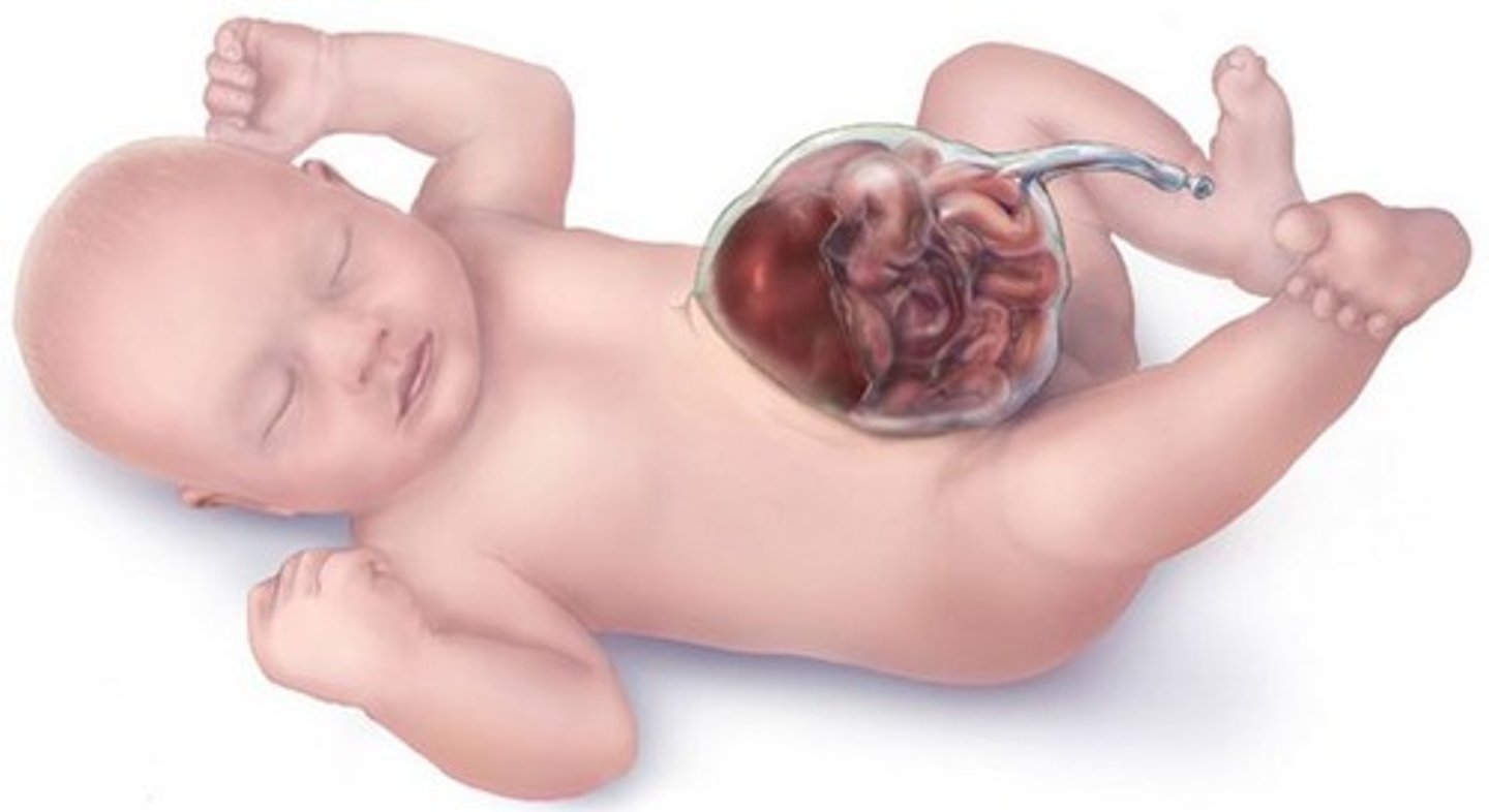 <p>(congenital) herniation at the umbilicus</p>