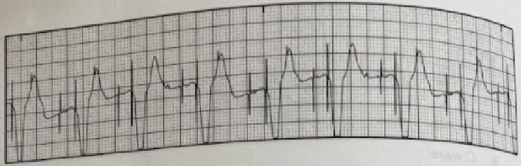 <p>Which of the following is shown on the EKG tracing?</p><p>A. Heart block</p><p>B. Pacemaker spikes</p><p>C. Ventricular fibrillation</p><p>D. Atrial flutter</p>