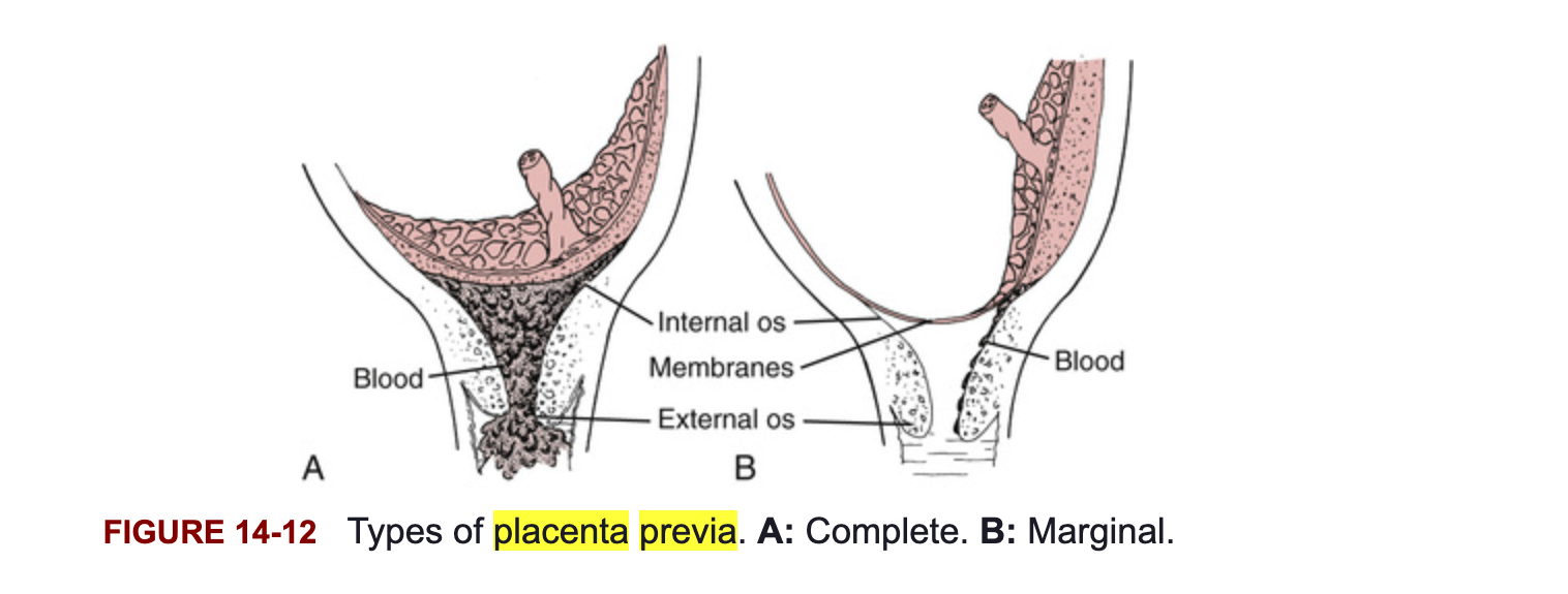 <p>Marginal placenta previa</p>