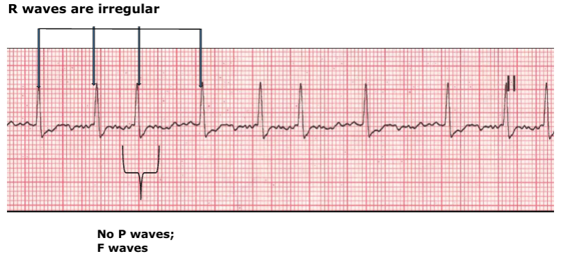 <p>there is a chaotic range of signals moving around the AV node, </p><p>this stimulates fibrillation instead of contraction in unison </p>