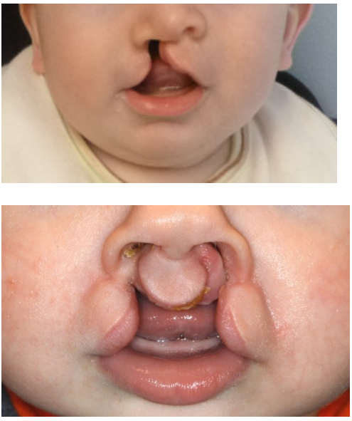 <p>Cleft lip is the partial or complete failure of fusion between the medial nasal processes and 1 or both maxillary processes.&nbsp;</p><ul><li><p>Incidence is 1:1000, twice as common in males</p></li><li><p>mandibular cleft lip is very rare</p></li><li><p><strong>Most common cleft lip is on UNILATERAL on the left side.&nbsp;</strong></p></li></ul><p></p>
