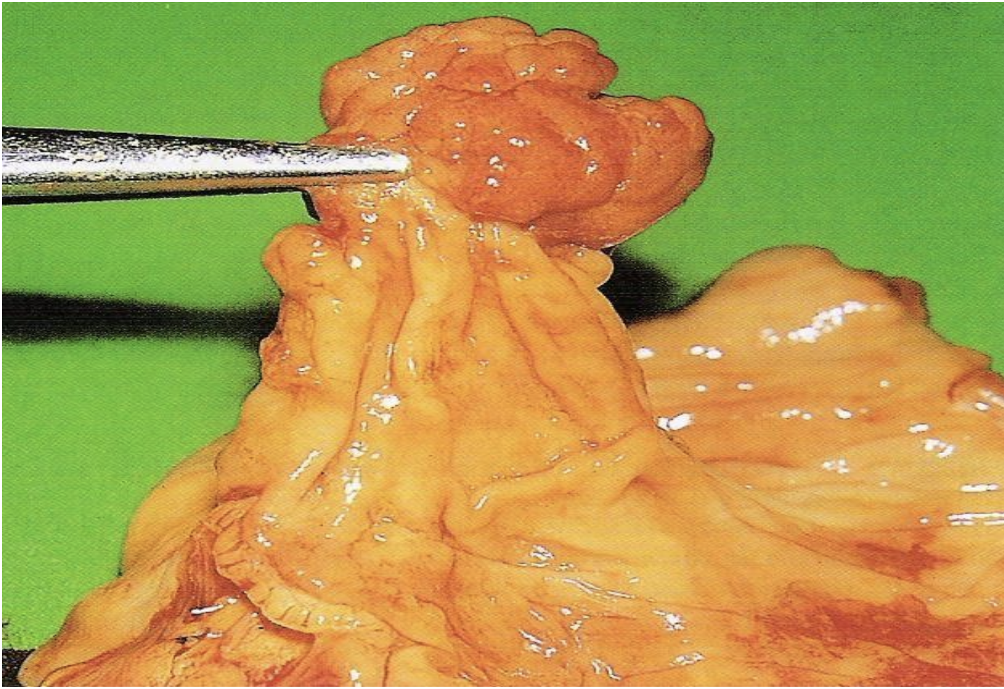 <p>Identify the <strong>organ</strong> and the <strong>diagnosis</strong> in this format: <em>diagnosis, organ</em></p>