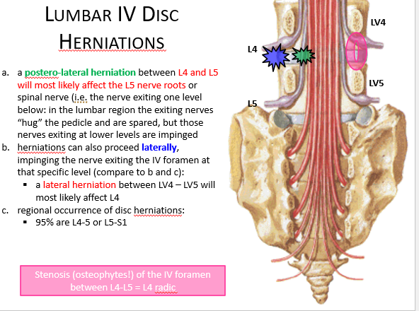 <p><span style="font-family: &quot;Bodoni MT&quot;">A paracentral or lateral herniation, will cause the transversing nerve root to be affected.</span><span>&nbsp;</span></p><p style="text-align: left"></p><p style="text-align: left"><span style="font-family: &quot;Bodoni MT&quot;">The L5 nerve root exits between the L5 and S1 foramina.</span><span>&nbsp;</span></p><p style="text-align: left"></p><p style="text-align: left"><span style="font-family: &quot;Bodoni MT&quot;">A lateral herniation of the L4-L5 disc would cause L5 radiculopathy.</span></p><p style="text-align: left"></p><p style="text-align: left"><span style="font-family: &quot;Bodoni MT&quot;">L5 radiculopathy would cause sensory loss around the great toe and top of the foot and decreased ability to extend the great toe (extensor hallucis longus)</span></p><p style="text-align: left"></p>