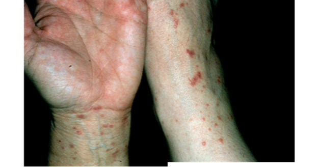 <p>tiny papules that coalesce to form plaques; Wickham striae present</p>