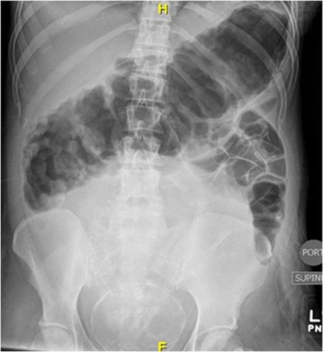 <p>A pt presents with abd pain, N/V/D, rectal bleeding (sometimes with tenesmus, fever, and electrolyte derangements). Upon PE you note abd distention, fever, tachycardia, and dehydration. On the KUB you see a large colon &gt;6mm-- waht is the likely dx?</p>
