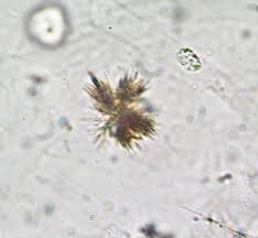 <ul><li><p>clumps of needles</p></li><li><p>associated with severe liver disease</p></li></ul><p></p>