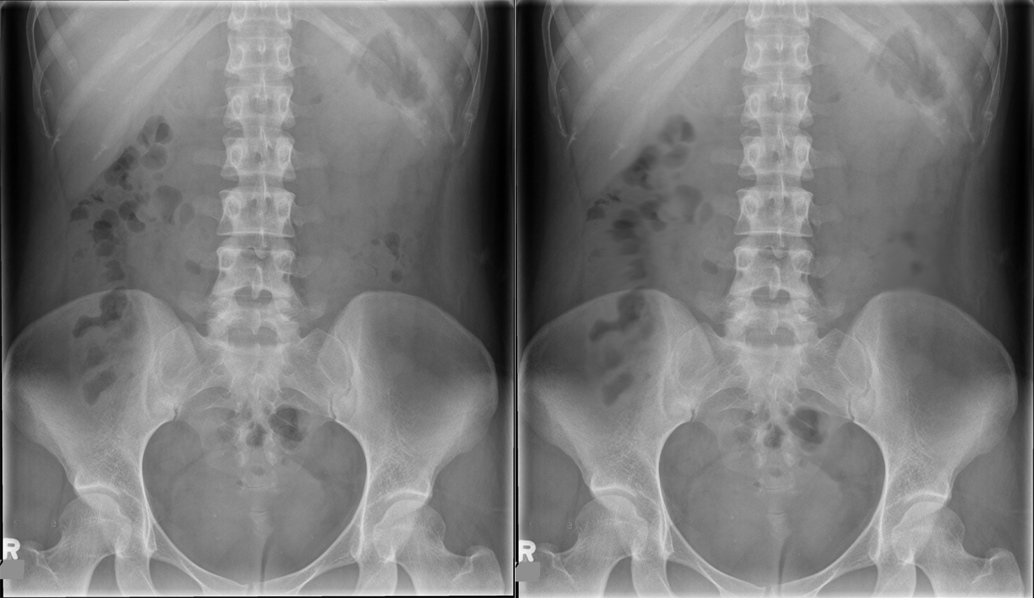 <p>Peristalsis; minimized using reduced exposure time but not completely preventable.</p>