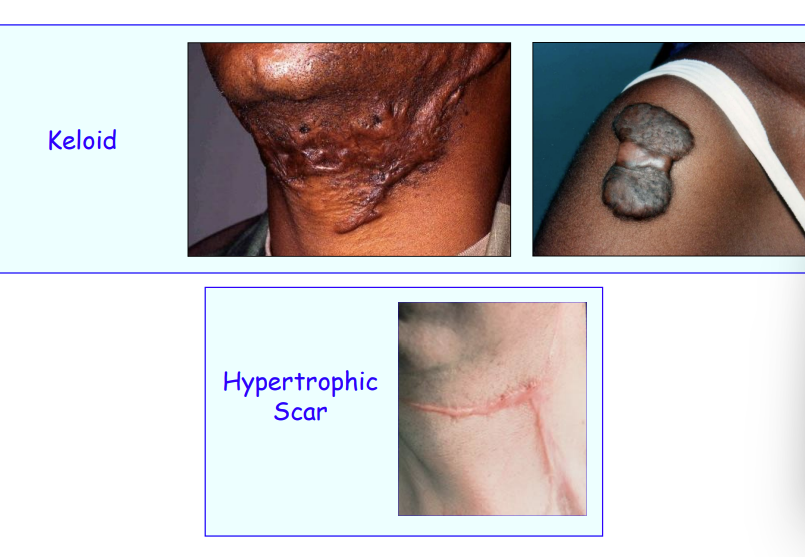 <p>complications from wound healing - <strong>hypertrophic </strong>scar formation </p>