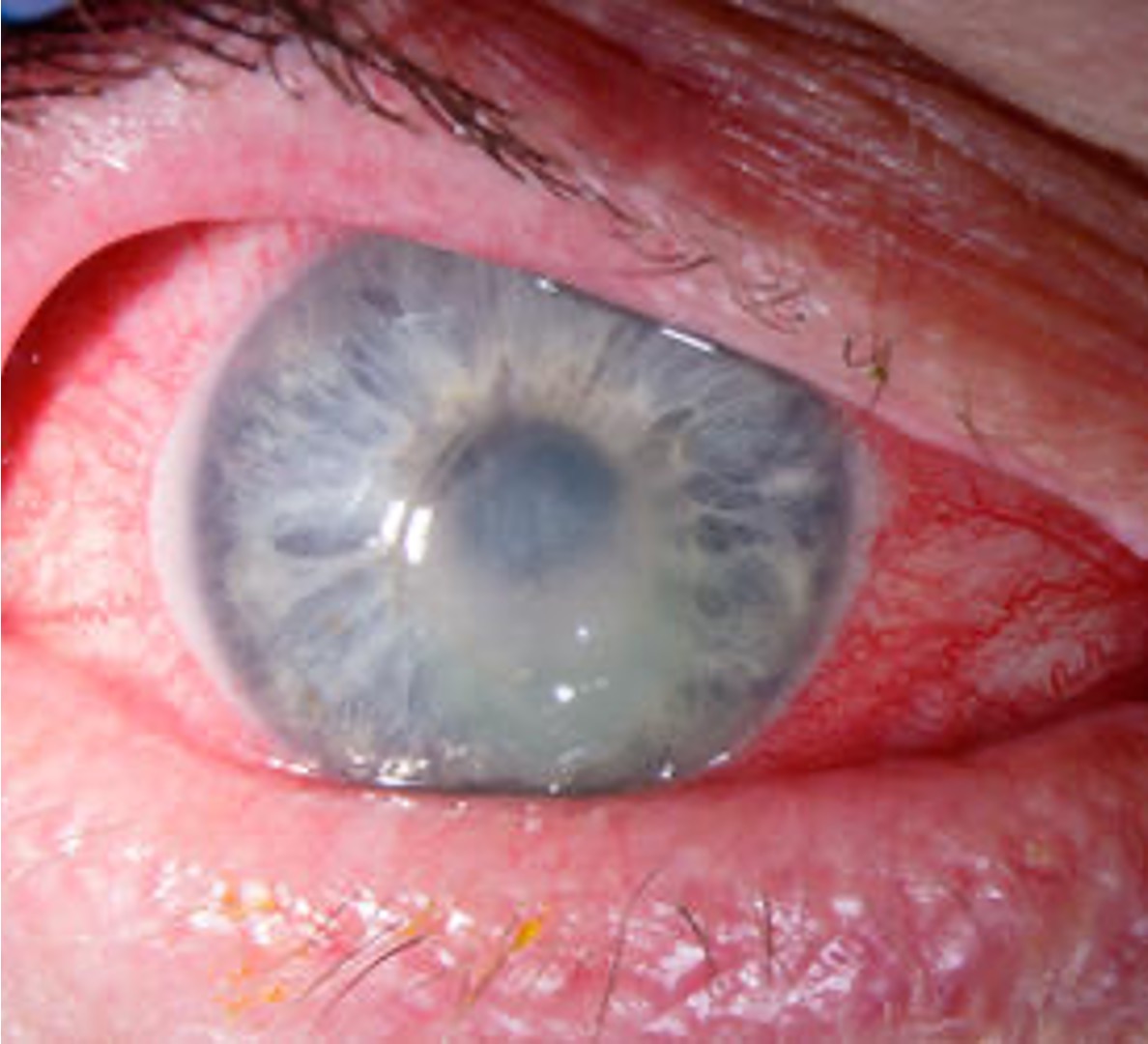 <p>What is the patient likely suffering from?</p><ul><li><p>They are a contact lens wearer</p></li><li><p>The patient has a history of blepharitis and dry eye</p></li><li><p>The eye is red, painful and watery</p></li><li><p>The lids are swollen</p></li><li><p>The patient is sensitive to light and feels something is getting in the way of their vision</p></li><li><p>On slit lamp examination, there is a white ulceration on the cornea as well as corneal infiltrates</p></li></ul><p></p>