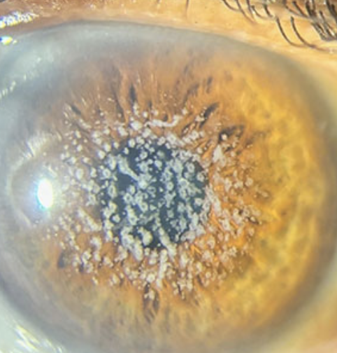 <p>One of the 6 Corneal Abnormalities</p><ul><li><p>Group of inherited disorders that cause <strong>abnormal deposits or growths</strong> in the<strong> corneal tissue</strong></p></li><li><p>Examples include Fuchs’ dystrophy and lattice dystrophy</p></li></ul><p></p>