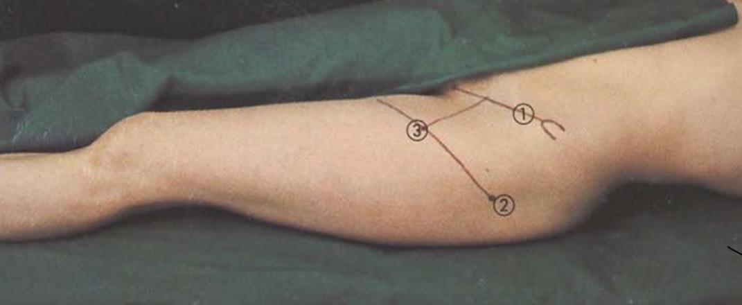 <p>n. ischiadicus priekinė blokados vieta</p>