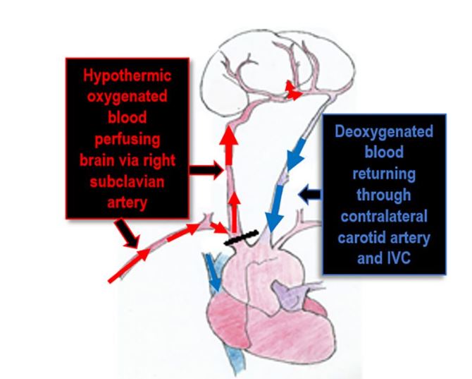 <ul><li><p>Hypothermic oxygenated blood perfusing brain via right subclavian artery (clamped off to aorta)</p></li><li><p>deoxygenated blood returning thru contralateral carotid artery &amp; IVC</p></li></ul><p></p>