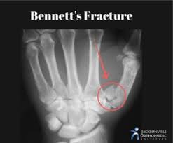 <ul><li><p><span>Etiology</span></p><ul><li><p><span>Occurs at carpometacarpal joint of the thumb as a resul of an axial and abduction force to the thumb</span></p></li></ul></li><li><p><span>Signs and symptoms</span></p><ul><li><p><span>CMC may appear to be deformed-X ray will indicate fracture</span></p></li><li><p><span>Athlete will complain of pain and swelling over the base of the thumb</span></p></li></ul></li></ul><p></p>