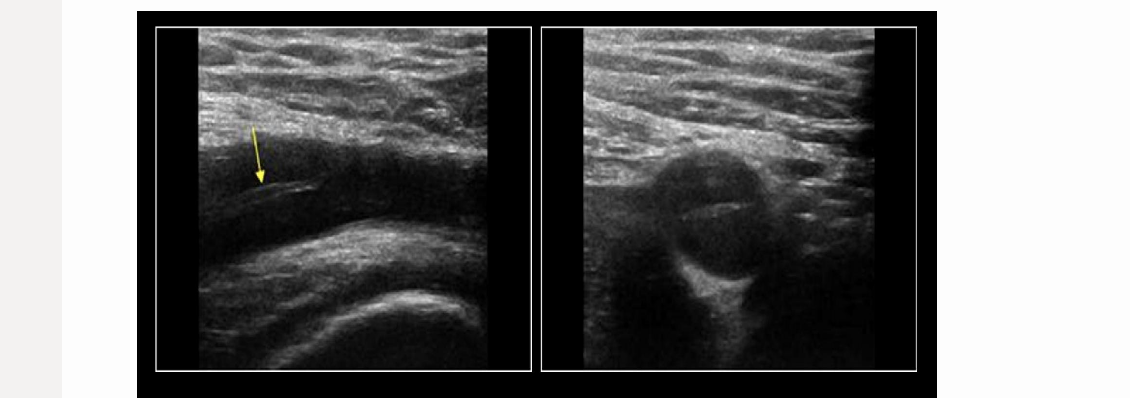 <p>this pic comes from the groin/lower extremity vascular scan</p><p><mark data-color="unset" style="background-color: unset; color: inherit;">.</mark></p><p><mark data-color="unset" style="background-color: unset; color: inherit;">a) floating thrombus strand from recanalized DVT in superficial femoral vein </mark></p><p><mark data-color="unset" style="background-color: unset; color: inherit;">b) normal common femoral artery bifurcation </mark></p><p><mark data-color="unset" style="background-color: unset; color: inherit;">c) iliac artery dissection </mark></p><p><mark data-color="unset" style="background-color: unset; color: inherit;">d) floating thrombus strand from recanalized DVT in iliac vein </mark></p>