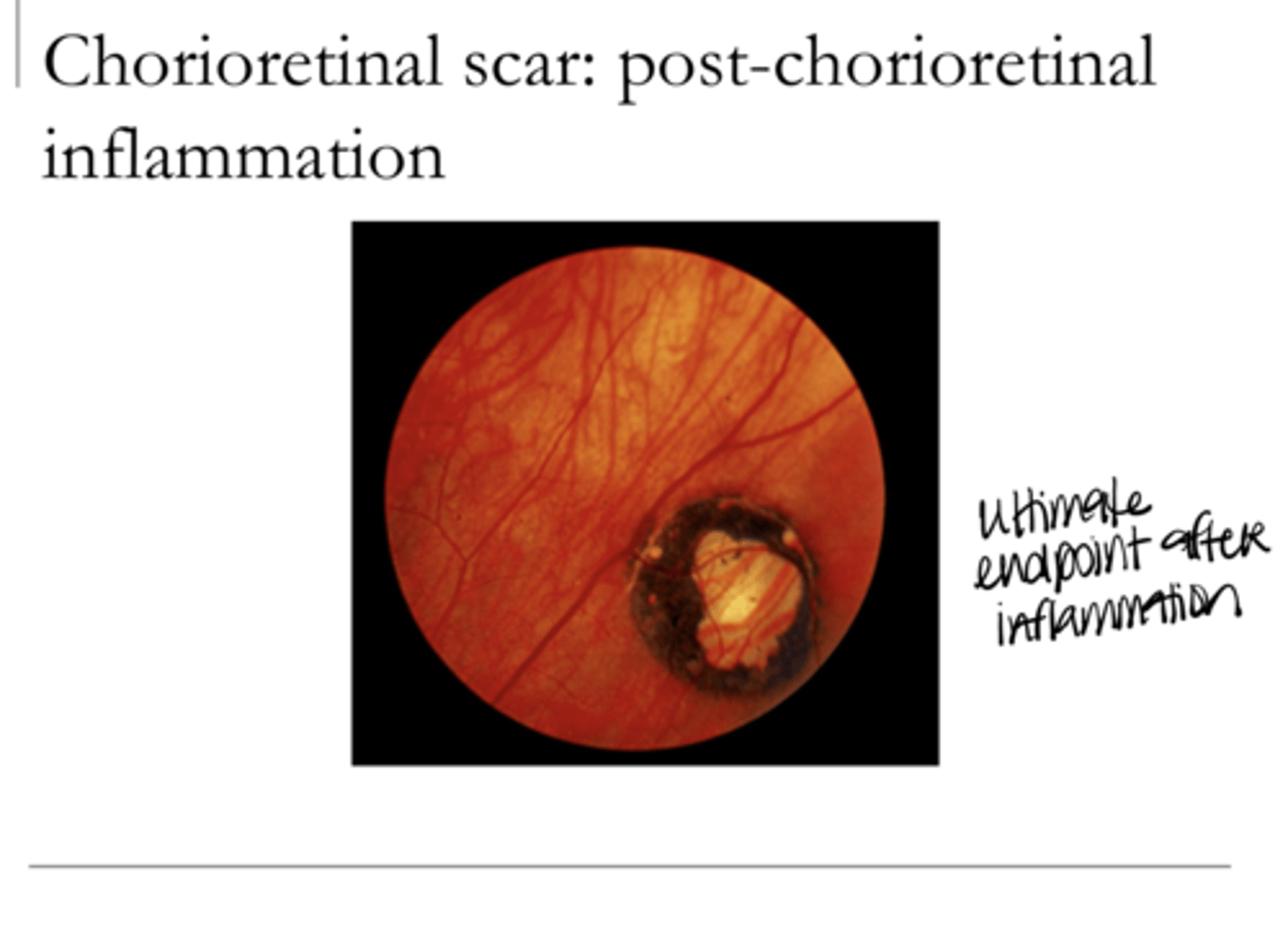 <p>Chorioretinal Scar -- Post Chorioretinal Inflammation Appearance (Pic)</p>