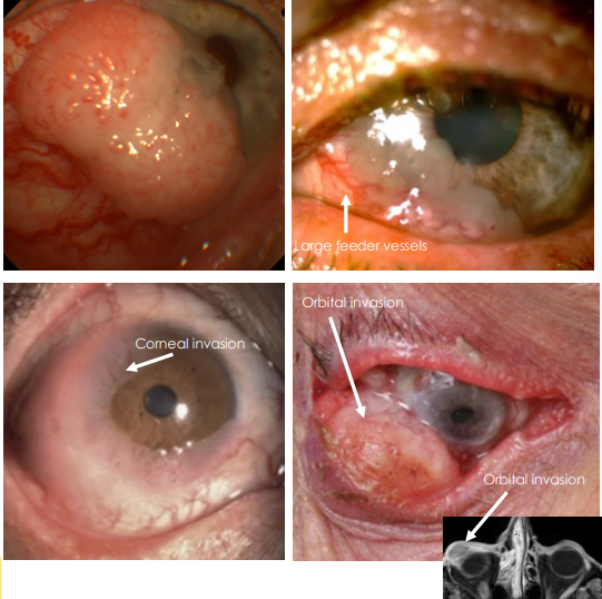<ol><li><p>Similar to Conjunctival Intraepithelial Neoplasia (CIN), <u>difficult to clinically differentiate between the two</u></p><ol><li><p>• Can have <strong><u>all characteristics of CIN:</u></strong></p><ol><li><p><u>• Papillomatous, Gelatinous, Lekoplakic</u></p></li></ol></li><li><p>• Can have: • <strong><u>(+) large, dilated feeder vessels</u></strong></p></li></ol></li></ol><p></p>