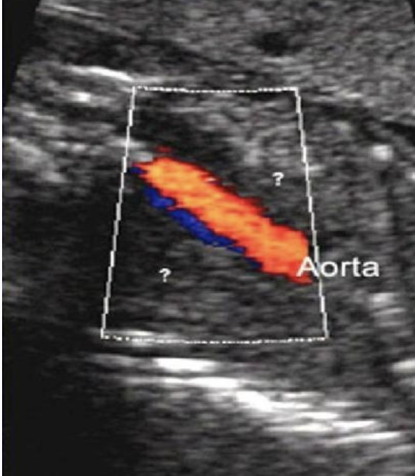 <p>which syndrome is commonly assoc w/this renal abn on this coronal image</p><p>a) turner</p><p>b) down</p><p>c) edward</p><p>d) potter </p>