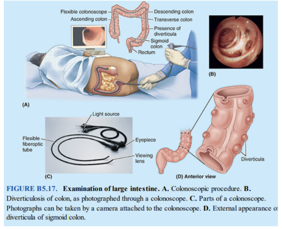 <ul><li><p>Procedure observing &amp; photographing the interior of the colon using a long, flexible fiberoptic endoscope (colonscope), inserted into the colon through the anus &amp; rectum</p></li><li><p>The interior of the sigmoid colon is observed with a sigmoidoscope — a shorter endoscope — in sigmoidoscopy</p></li><li><p>Small instruments can be passed through both instruments &amp; used to facilitate minor operative procedures — ex. biopsies or polyps removal</p><ul><li><p>Most tumors of the large intestine occur in sigmoid colon &amp; rectum (often near rectosigmoid junction), or ascending colon</p></li></ul></li><li><p>Colorectal cancers have different characteristics based on where they are in the colon or rectum —</p><ul><li><p>Ex. tumors in ascending colon are more common among women &amp; older patients, whereas rectosigmoidal tumors are more common among men &amp; younger patients. Cancers of transverse or descending colon are less common </p></li></ul></li></ul>