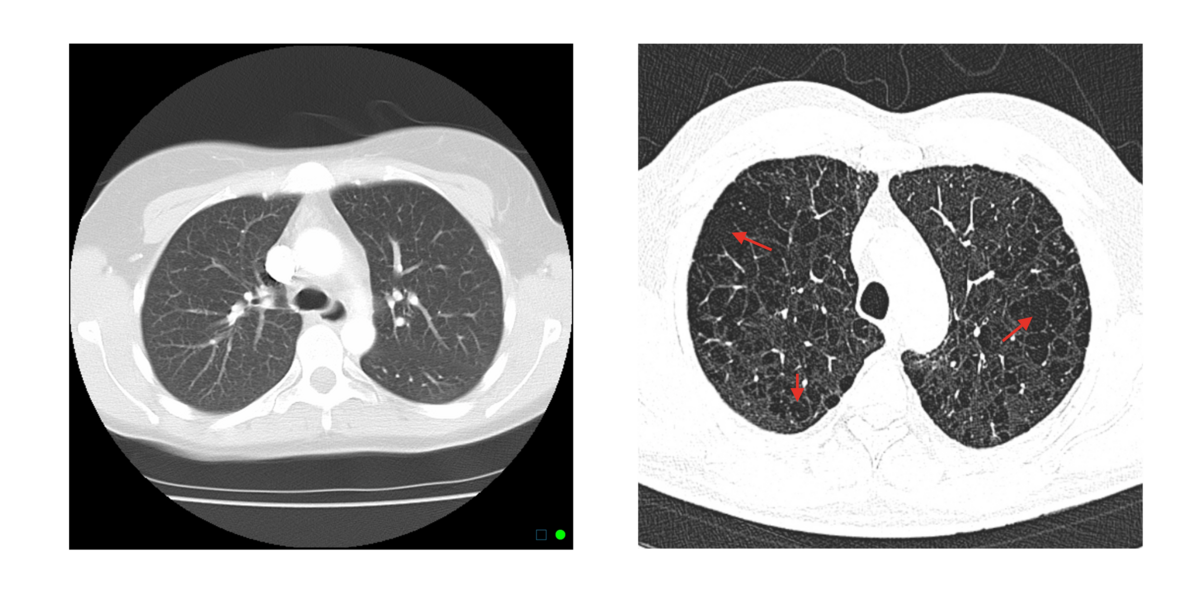 Røntgen:

\-Tøndeformet thorax, flade diaphragmakupler og evt udtyndet kartegning

\
CT (HRCT):

\-Kan vise specifikt hvor det alvorlige emfysem sidder i lungen

\-Områder med lav attenuation (der septa er væk, og der er større huller end der skal være)