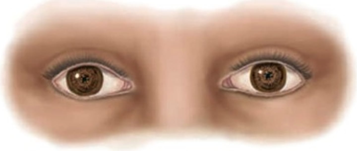 <p>Bilateral, miotic, irregularly shaped pupils that fail to constrict with light but retain constriction with convergence</p>
