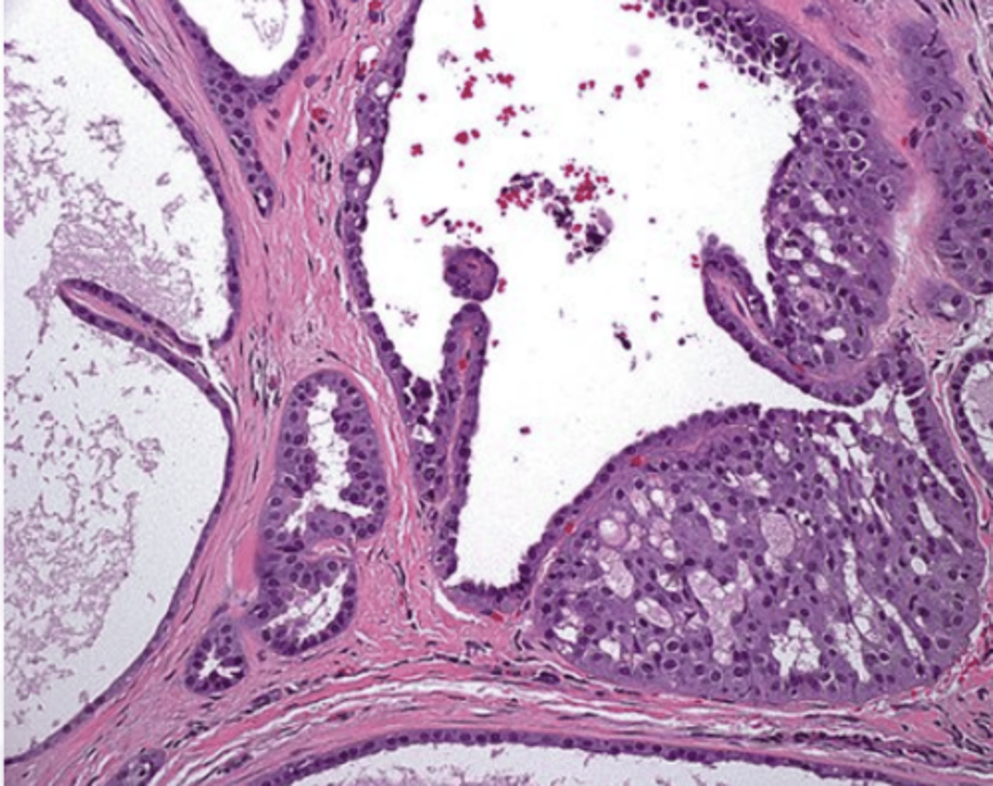 <p>These histologic characteristics are indicative of what oral pathology?</p><p>Zymogen poor</p><p>Very bland cytology</p><p>"Hobnail cells"</p>