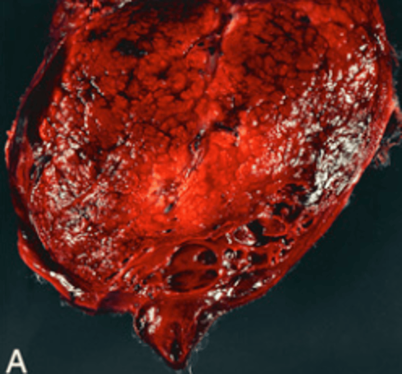 <p>What type of necrosis is being shown in this image?</p>