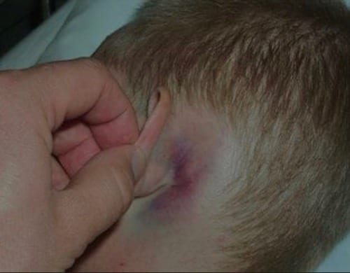 <p>Middle fossa skull base fracture clinical presentations</p>