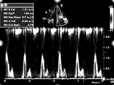<p>what diastolic pattern is shown here?</p>