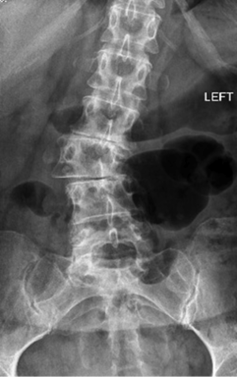 <p>ID type of joint alignment change</p>
