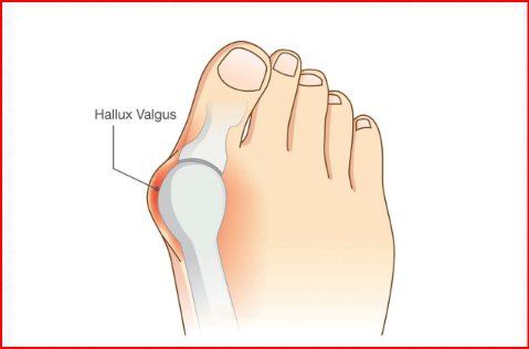 <p>Câu 12: Hallux <span style="color: yellow;">valgus</span> là gì?<span>&nbsp;</span></p><p class="MsoNormal">A. Ngón chân cái <span style="color: purple;">đưa vào trong </span>(<span style="color: green;">vẹo ngón cái vào trong</span>)<span style="font-family: "Segoe UI Symbol", sans-serif;"><span>✓</span></span><span>&nbsp;</span></p><p class="MsoNormal">B. Ngón chân cái đưa ra ngoài<span>&nbsp;</span></p><p class="MsoNormal">C. Ngón chân hình búa<span>&nbsp;</span></p><p class="MsoNormal">D. Ngón chân chồng lên nhau<span>&nbsp;</span></p>
