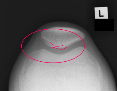 <ul><li><p>apex and base SI</p></li><li><p>open pat-fem joint</p></li></ul><p></p><p>excessive</p><ul><li><p>apex more ant to base</p></li></ul><p>insufficient</p><ul><li><p>apex post to base </p></li></ul><p></p>