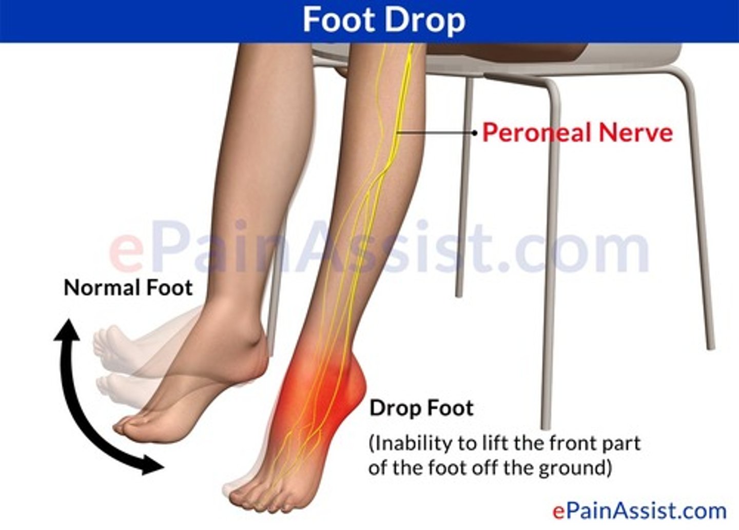<p>Trauma/compression of the nerve results in paresthesias in the lateral lower leg, dorsal foot/1st toe web space, weakness w/ dorsiflexion, &amp; possible foot drop</p>